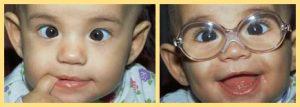 Pri liečbe strabizmu u detí je dôležité určenie správnej korekcie a jej nosenie. Zväčša ide o okuliarovú korekciu, ktorá úplne alebo čiastočne odstráni úchylku.